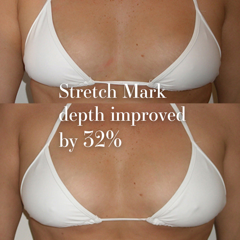 Boustise bust serum user Kayla results reviews before after 8 weeks for stretch marks 